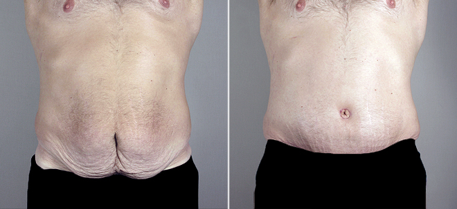 Front view of male patient before and after abdominoplasty