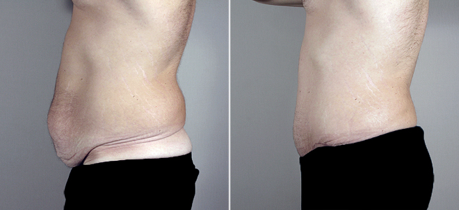 Side view of male patient before and after abdominoplasty