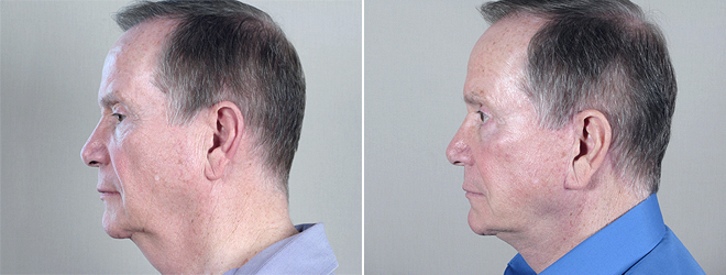 Side view of male patient before and after liposuction