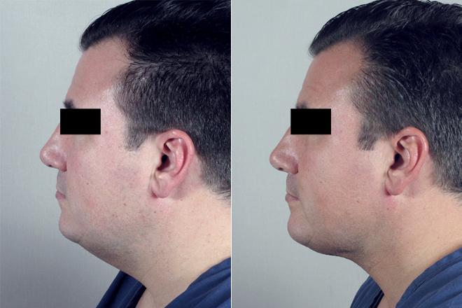 Side view of male patient before and after neck contouring