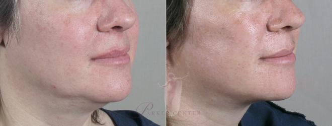 La línea de la mandíbula de una mujer antes y después de la liposucción de cuello
