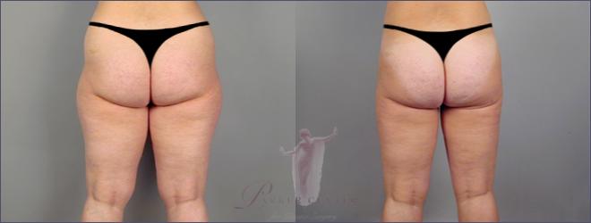 Vista trasera de los muslos de la mujer antes y después de la liposucción