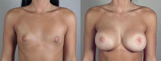 Woman\'s chest before and after breast implants