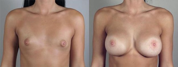 Woman's chest before and after breast implants