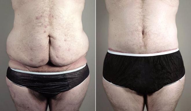 Front view of male patient before and after abdominoplasty