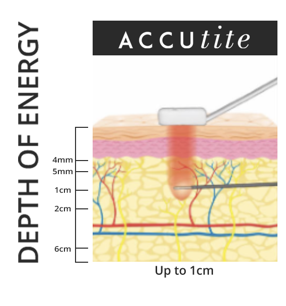 AccuTite penetrates into the skin up to 1 cm