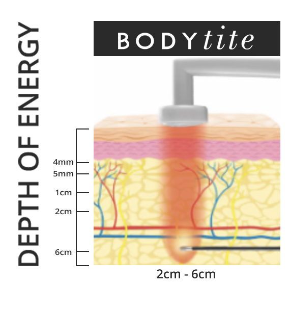 BodyTite penetrates into the skin 2 to 6 cm