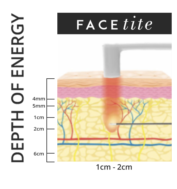FaceTite penetrates into the skin 1 to 2 cm