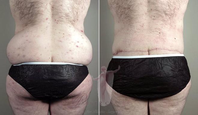 Rear view of man before and after body lift