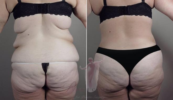 Woman\'s backside before and after body lift