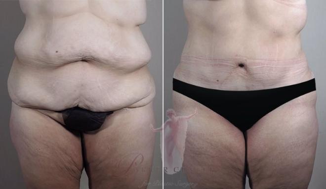 Body Lift or Lower Body Lift - American Society of Bariatric Plastic  Surgeons (ASBPS)