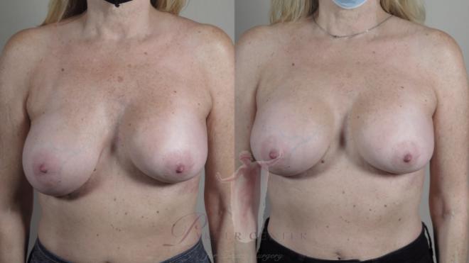 Woman\'s chest before and after breast augmentation revision