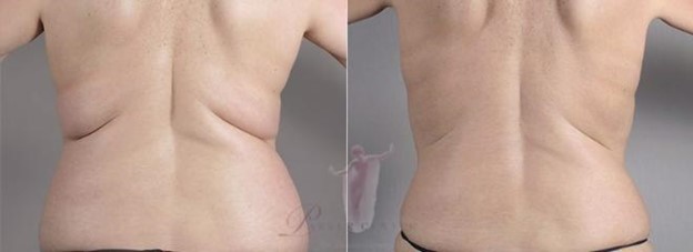 Woman\'s back before and after CoolSculpting