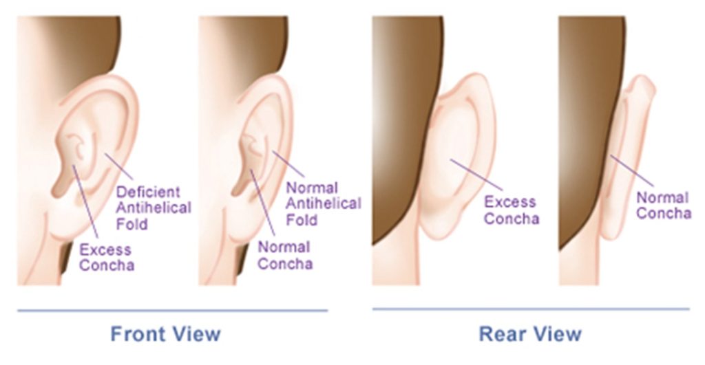 Problems fixed with otoplasty include deficient antihelical fold and excess concha,