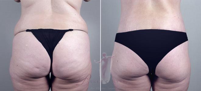 Woman\'s backside before an after body lift surgery