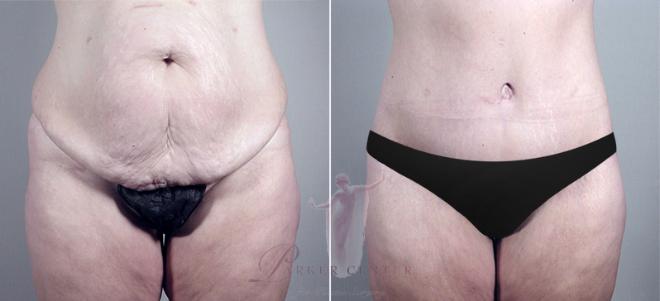 Woman\'s abdomen before and after a tummy tuck