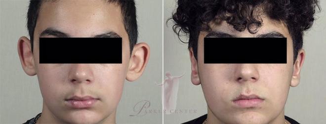 Boy before and after otoplasty