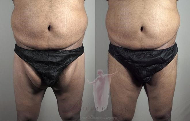 Thigh lift for men before and after photos