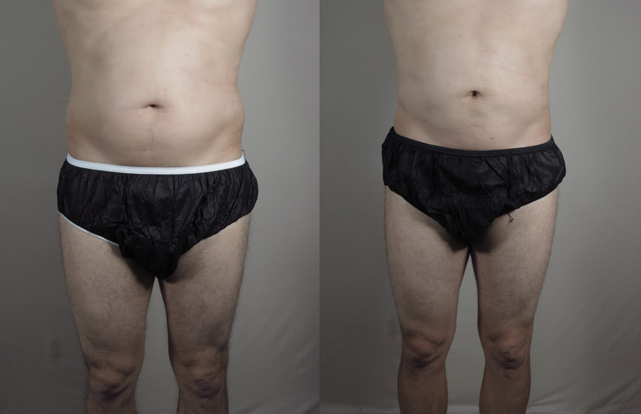 Man\'s abdomen before and after BodyTite