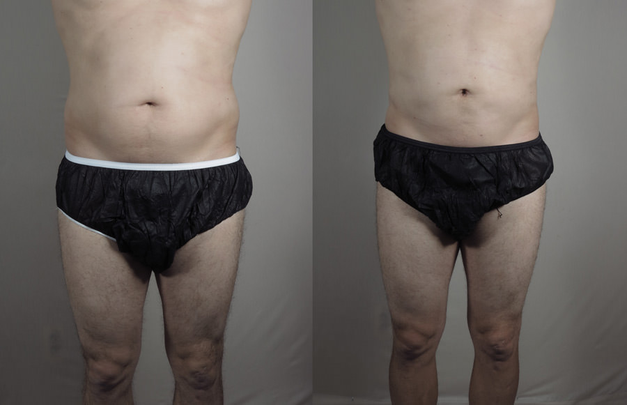 Man's abdomen before and after BodyTite