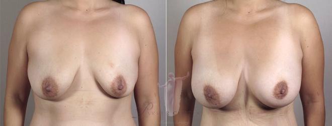 Breast augmentation deflated breasts before and after