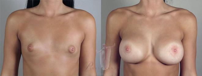 Woman\'s chest before and after breast implants
