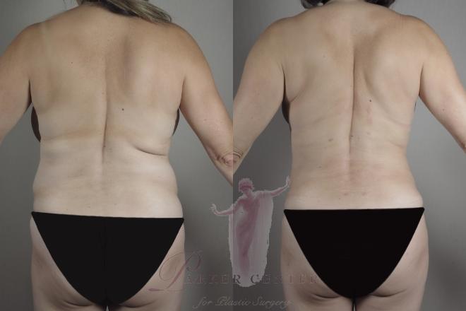 Woman\'s back before and after BodyTite and liposuction