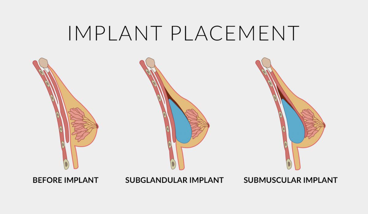 Implant placement options are under the breast tissue or under the chest muscle