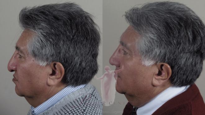 Man\'s profile before and after rhinoplasty