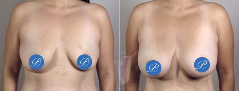 Before and after photos of breast augmentation for deflated breasts