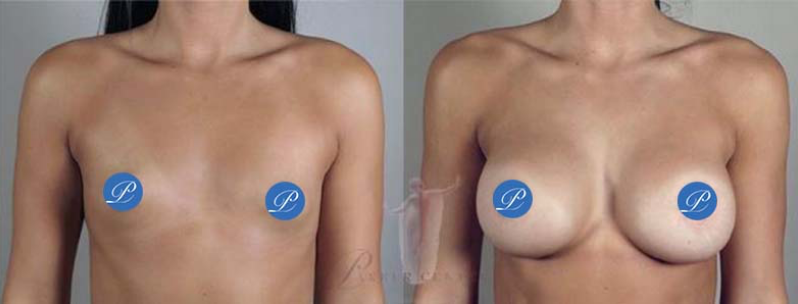 Before and after photos of breast augmentation to correct tuberous breasts