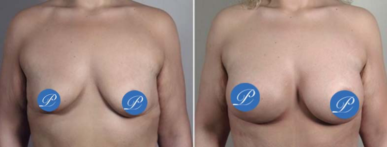 Before and after photo of breast augmentation for mild to moderate breast sagging
