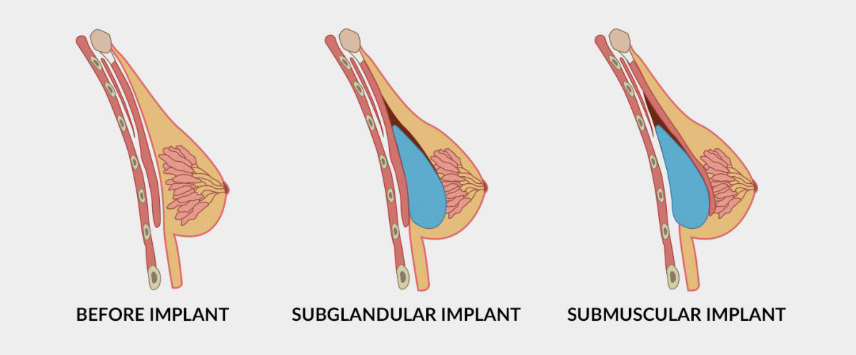 Graphic showing subglandular vs submuscular breast implant placement.