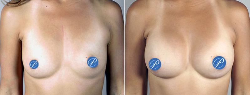 woman before and after breast augmentation to correct asymmetry