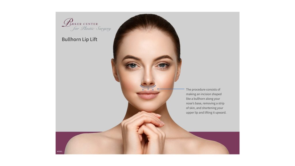 bullhorn lip lift