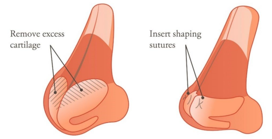 Illustration showing open rhinoplasty technique