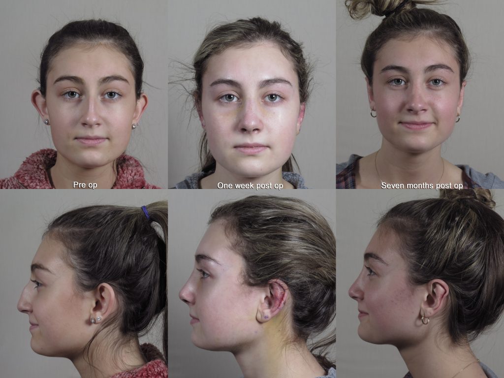 six images showing rapid recovery from rhinoplasty pre op, one week post op then seven months post op