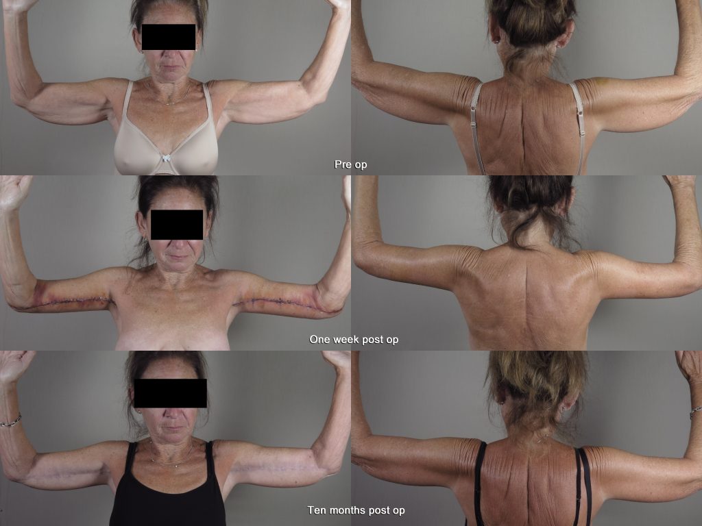 Before and after images showing recovery times of arm lift with rapid recovery, one week and ten months post op