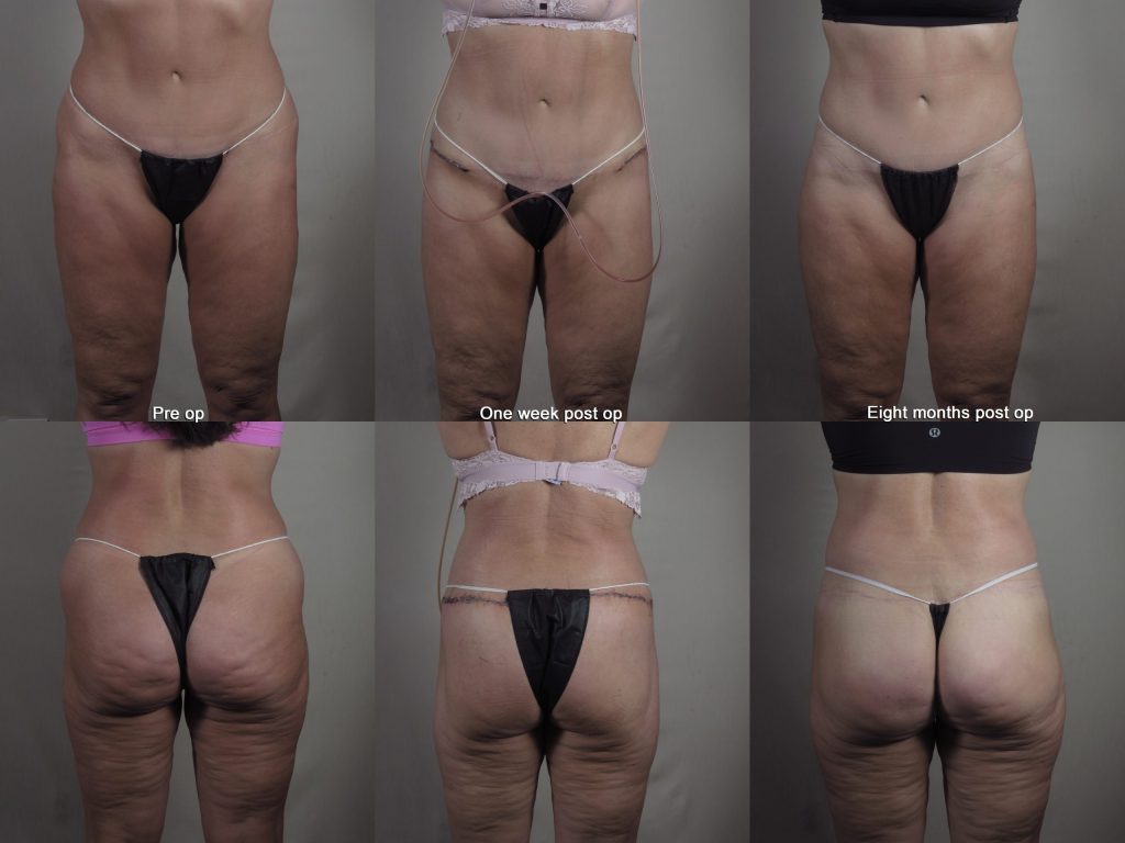 Body lift recovery results after one week and eight months post op with rapid recovery