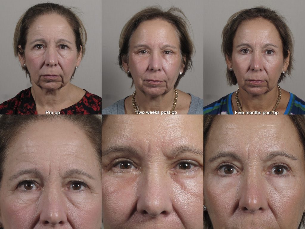 Brow lift before and after photo showing recovery after two weeks post op and five months with rapid recovery