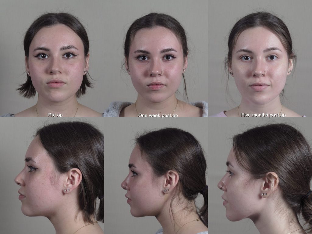 Before and after images of Buccal Fat removal with rapid recovery showing one week post op and five months post op results.