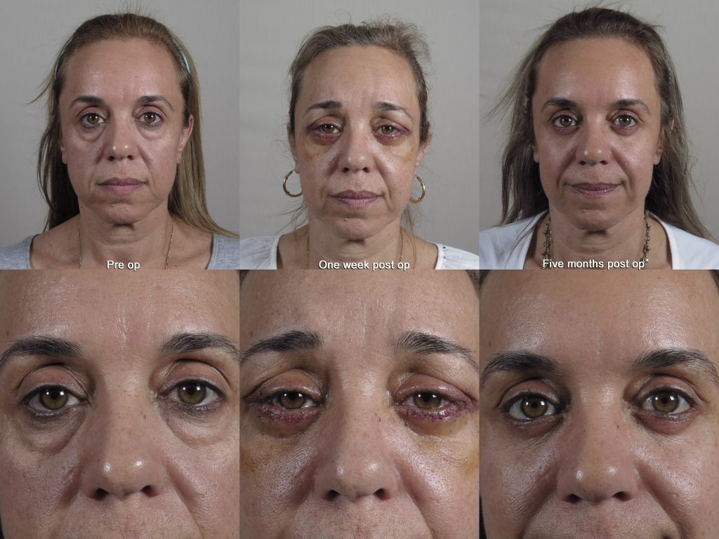 Eyelid surgery results one week post op and five months post op with rapid recovery