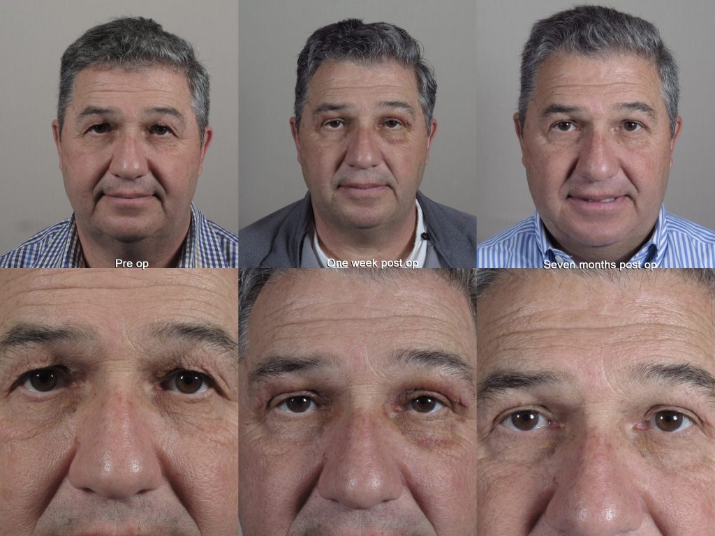 before and after images of eyelid surgery pre-op, one week post op and seven months post op