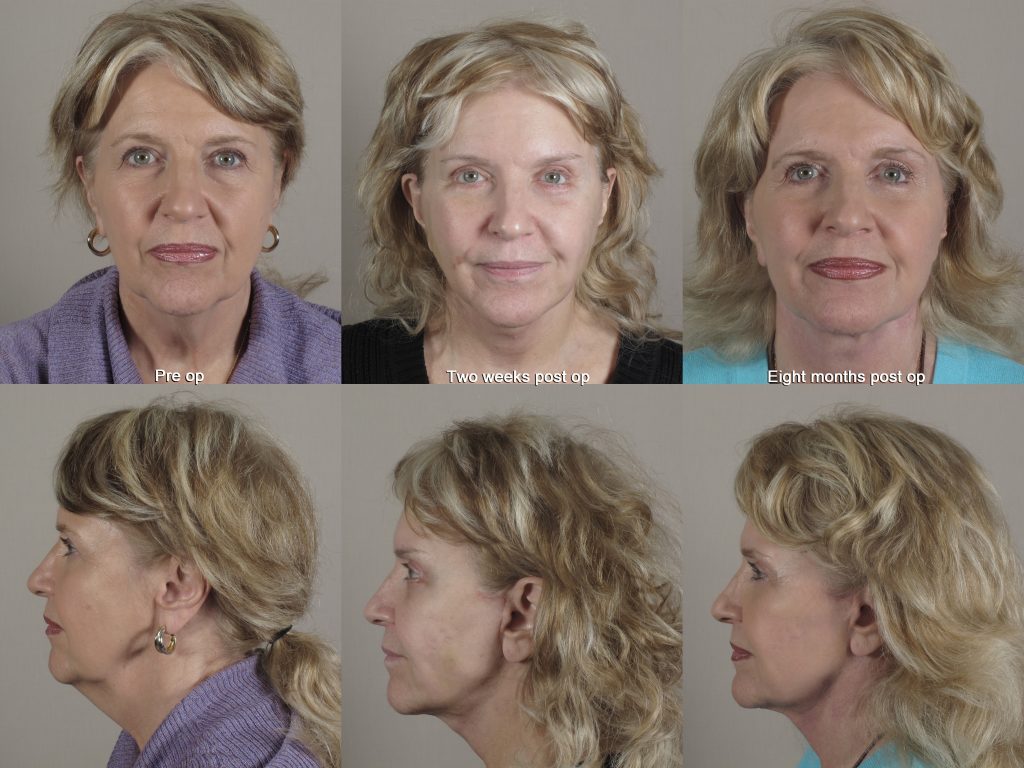 before and after images of facelift pre-op, two weeks post op and 8 months post op