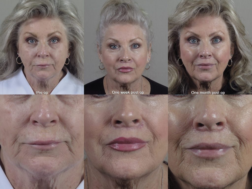 Lip lift before and after images with rapid recovery showing one week post op and one month post op