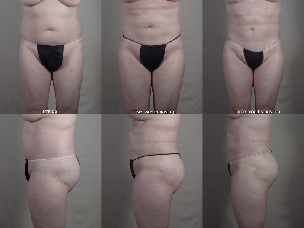 Recovery results for liposuction with rapid recovery showing two weeks and three months post op