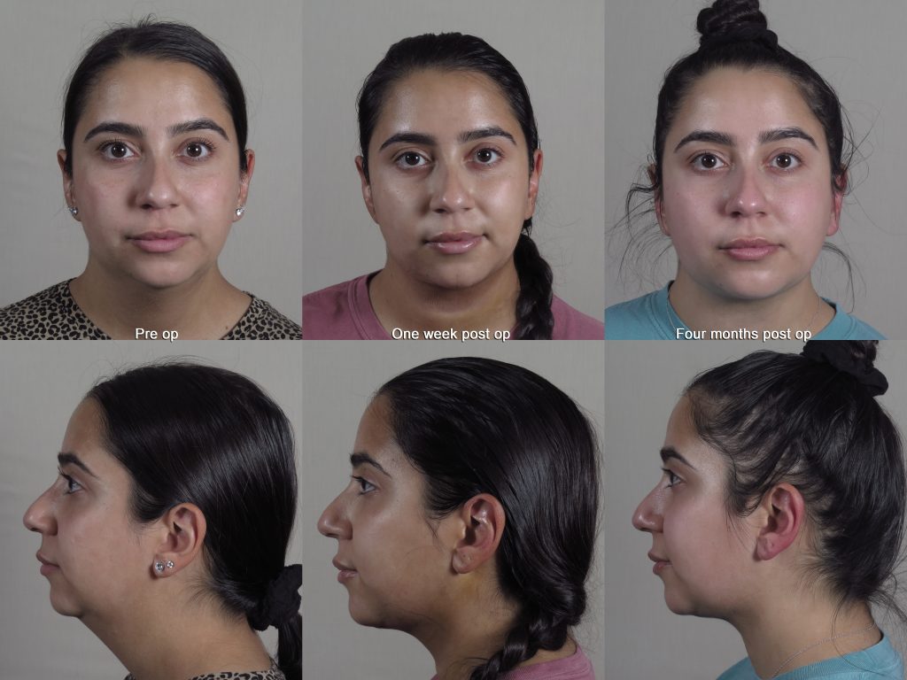 Neck contouring before and after photo showing recovery after one week post op and four months post op with rapid recovery
