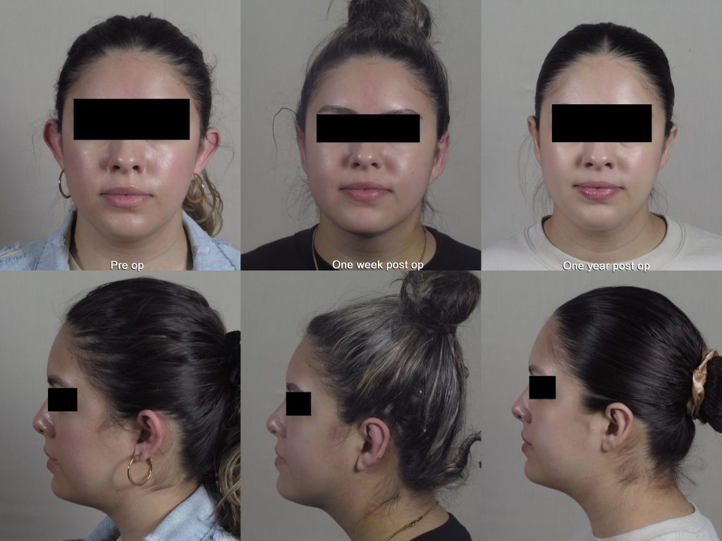 Otoplasty before and after photo showing recovery after one week post op and one year with rapid recovery