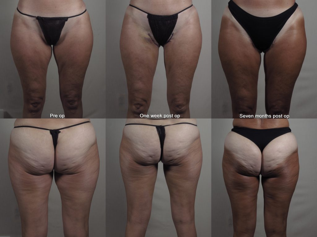 Before and after image of a thigh lift with rapid recovery showing one week and seven months post op.