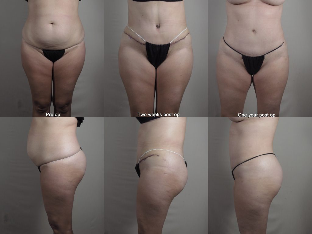 Tummy Tuck results with rapid recovery showing two weeks and one year post op.